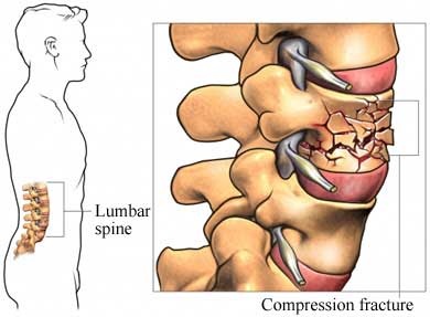 osteoporosis spinal compression fracture treatment